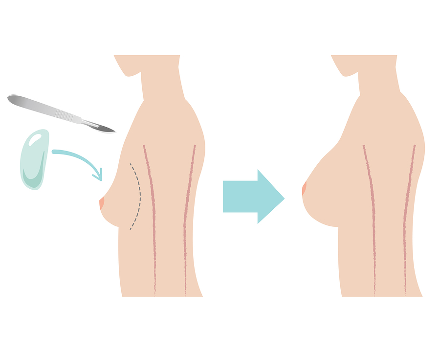 breast augmentation before & after