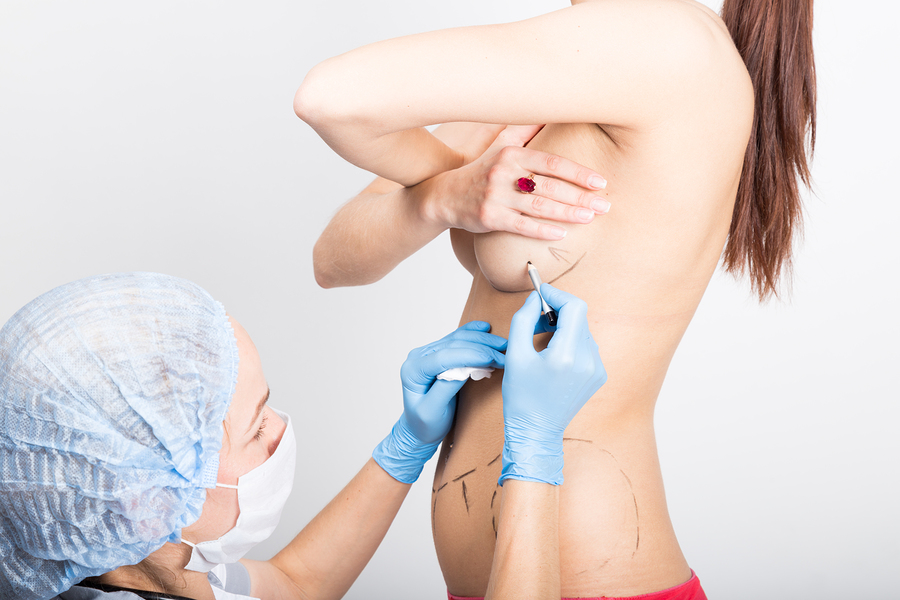 Surgeon Drawing Cut Lines Under Females Breast