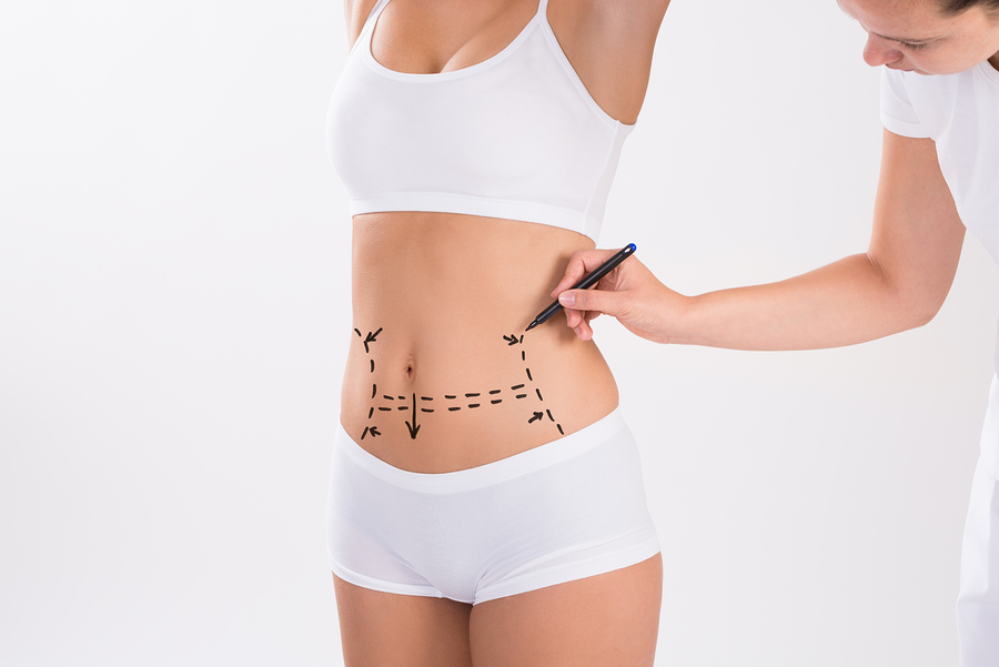 Female Doctor Drawing Lines On A Womans Abdomen With Marker