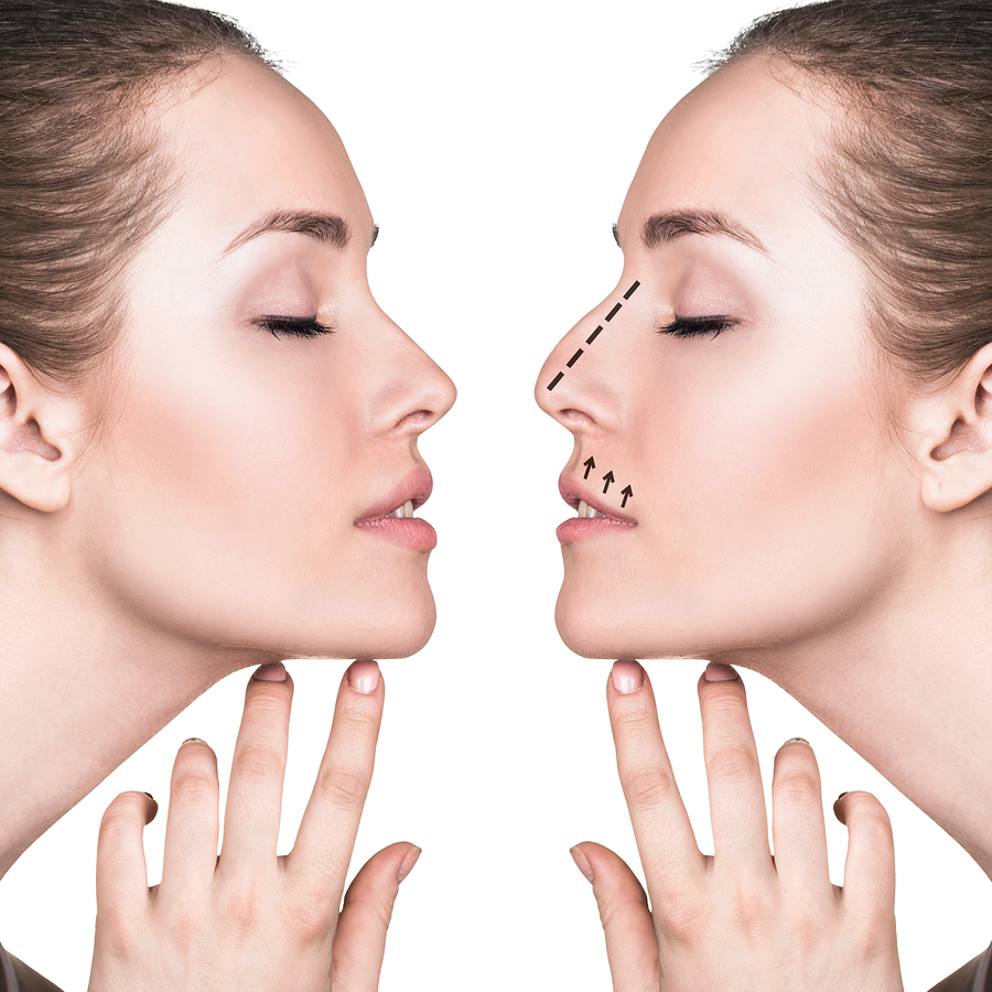 Mirror Image of Model Showing Before and After Rhinoplasty