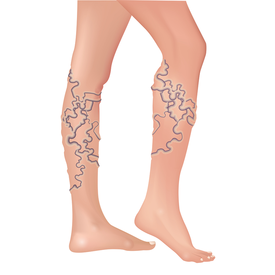 Sclerotherapy Treatment of Leg Veins
