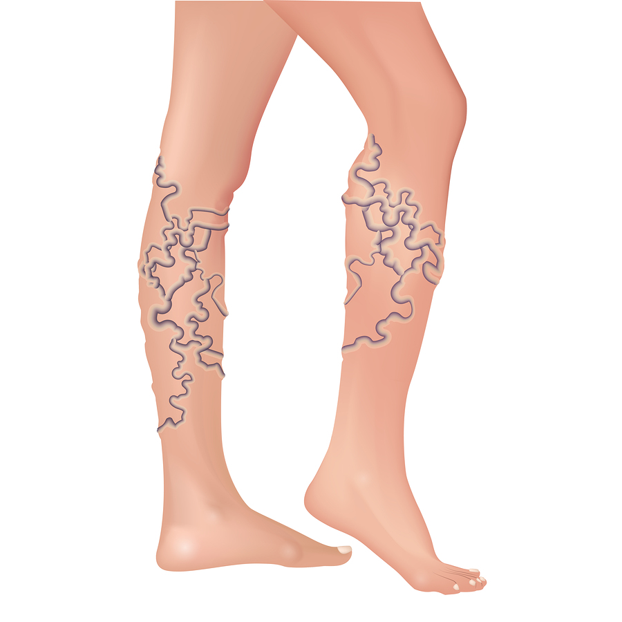 Varicose Vein Treatment in Arlington, TX