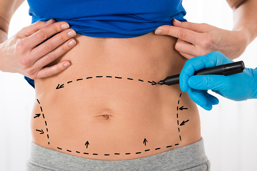Minimizing Abdominoplasty Scars