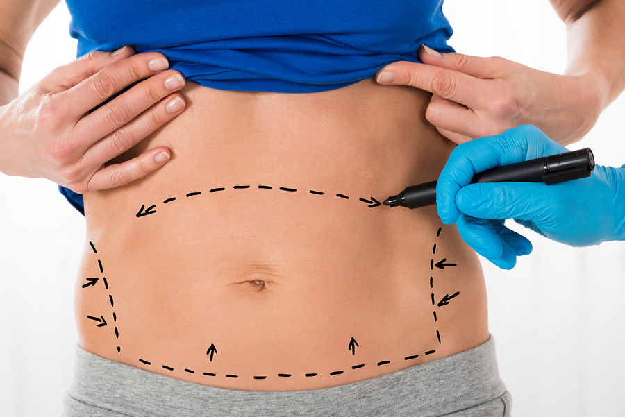 Tummy Tuck Scars