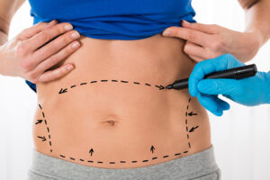 Female Torso With Surgeons Hand Drawing Cut Lines on Abdomen