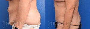 Patient 1 Before and After Abdominoplasty Left Side View