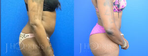 Patient 11a Before and After Liposuction Right Side View