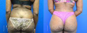 Patient 11b Before and After Liposuction Back View