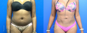 Patient 11c Before and After Liposuction Front View