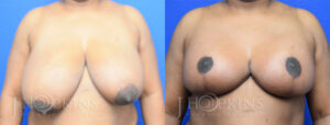 Patient 4 Before and After Breast Reduction Front View