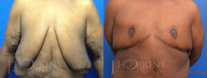 Patient 1 Before and After Male Breast Reduction Front View