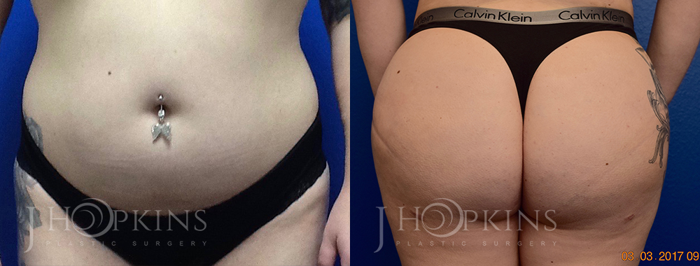 Patient 1 Before and After Fat Transfer