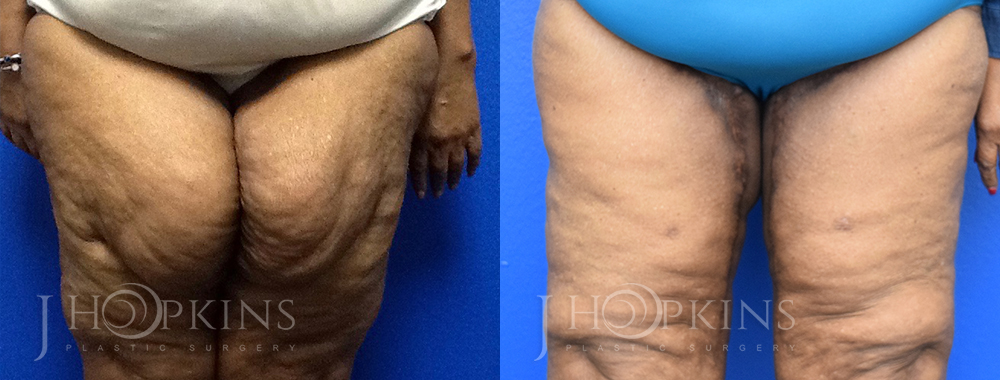 Patient 1 Before and After Thighplasty Front View