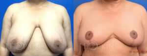 Patient 3 Before and After Breast Reduction Front View
