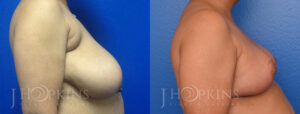 Patient 1 Before and After Breast Reduction Right Side