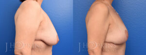 Patient 1 Before and After Breast Lift Right Side View