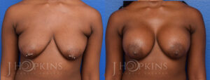 Breast Augmentation Before and After Photo - Patient 1a