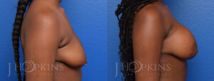 Breast Augmentation Before and After Photo - Patient 1b