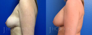 Breast Augmentation Before and After Photos - Patient 2b