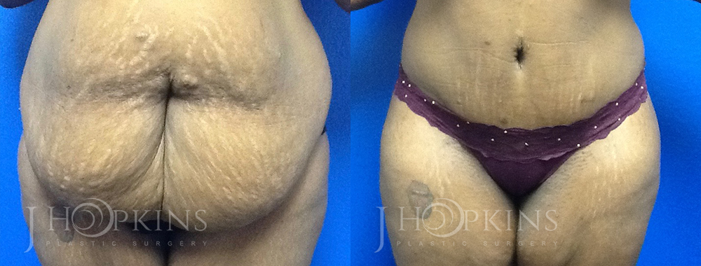 Panniculectomy Before and After Photos - Patient 1A