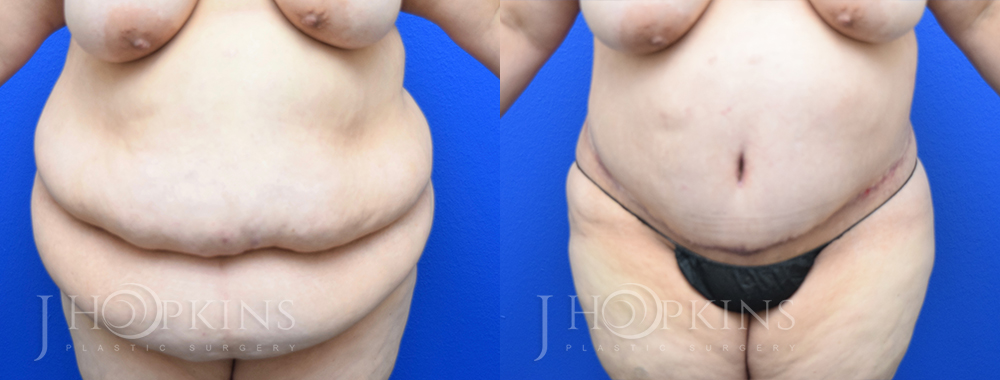 Panniculectomy Before and After Photos - Patient 2A