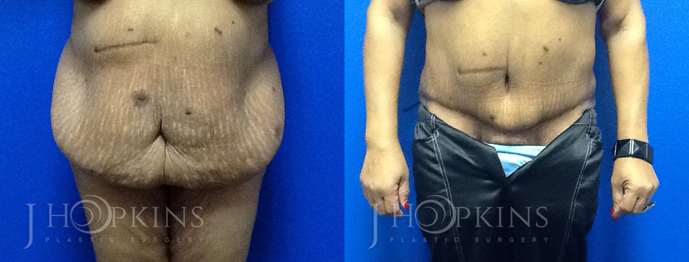 Panniculectomy Before and After Photos - Patient 4