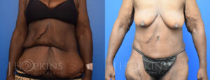Panniculectomy Before and After Photos - Patient 8A