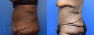 Panniculectomy Before and After Photos - Patient 8B