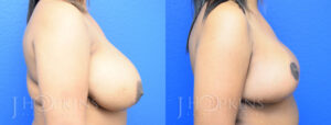 Patient 5 Before and After Breast Reduction Right Side View