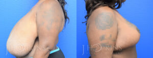 Patient 6 Before (Left Side) and After (Right Side) Breast Reduction