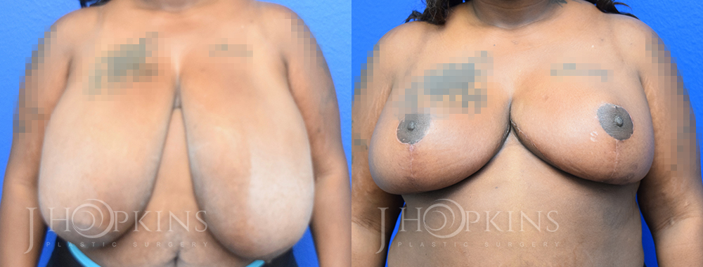 Patient 6 Before and After Breast Reduction Front View