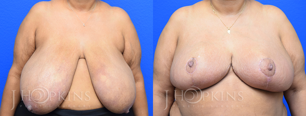 Patient 7 Before and After Breast Reduction Front View