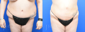 Patient 9 Before and After Liposuction Front View