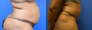 Patient 3 Before and After Tummy Tuck Right Side View
