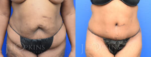 Panniculectomy Before and After Photos - Patient 10A