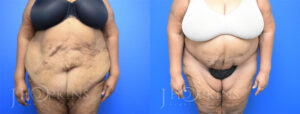 Panniculectomy Before and After Photos - Patient 11B