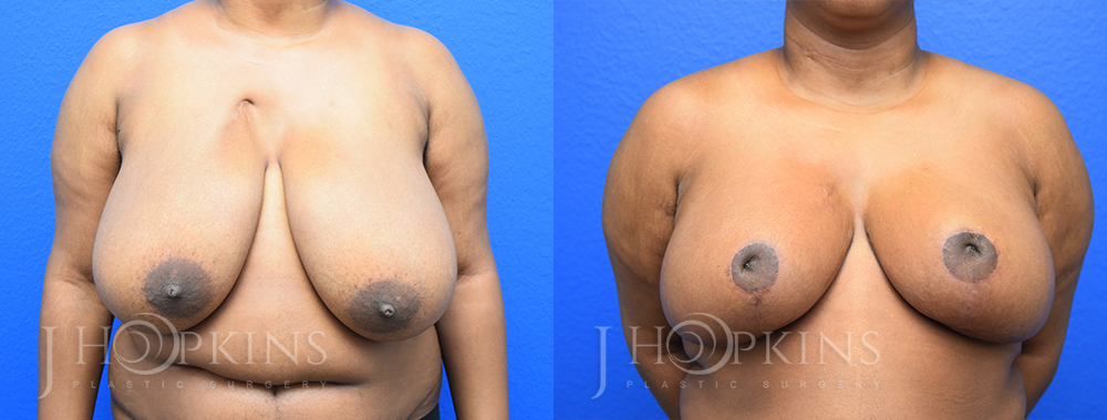 Patient 9 Before and After Breast Reduction Front View