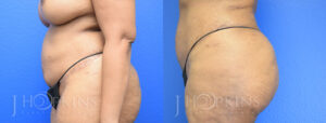 Liposuction Before and After Patient 4a