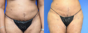 Liposuction Before and After Patient 4b