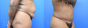 Patient 5a Before and After Tummy Tuck Front View