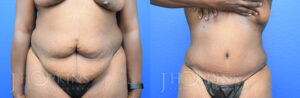 Patient 5b Before and After Tummy Tuck Front View