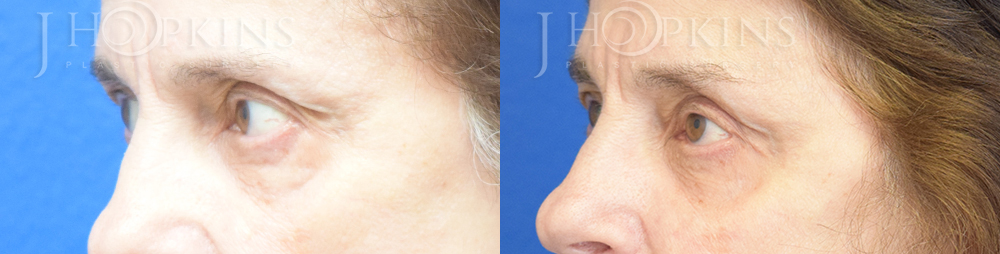 Blepharoplasty Before and After Photos - Patient 3A