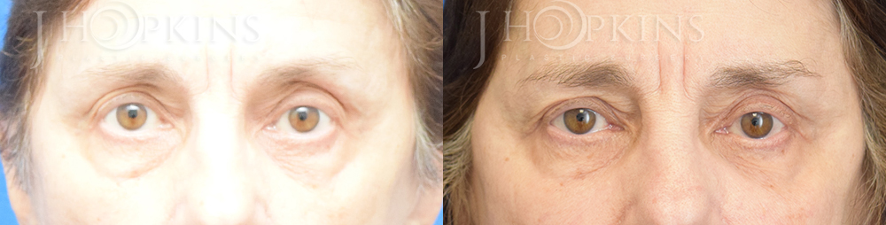 Blepharoplasty Before and After Photos - Patient 3B