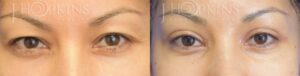 Blepharoplasty Before and After Photos - Patient 4A