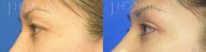 Blepharoplasty Before and After Photos - Patient 4B