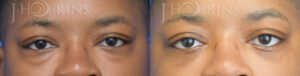 Patient 5B Before and After Blepharoplasty Front View