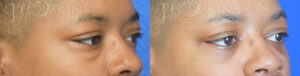 Patient 5B Before and After Blepharoplasty Right Side Angle View