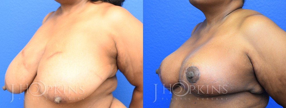 Breast Reduction Before and After Photos - Patient 10A