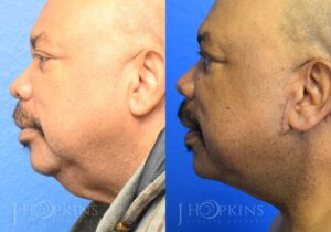Neck Lift Before and After Photos - Patient 1A