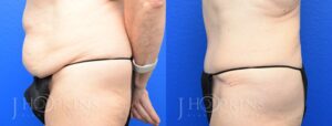 Tummy Tuck Before and After Photos - Patient 7B
